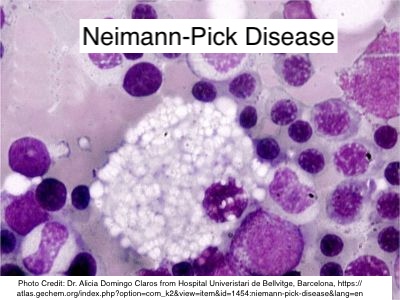 Gaucher v. Niemann-Pick.  

Both involve Macrophages + 🧬 AR

Former: Glucocerebroside ⬆️; Looks like CRUMPLED tissue paper

Latter: Sphingomyelin ⬆️; FOAMY, VACUOLATED cytoplasm

#pathx #genetics #hemepath #heme #medicalstudent #pathtwitter #pedsx
