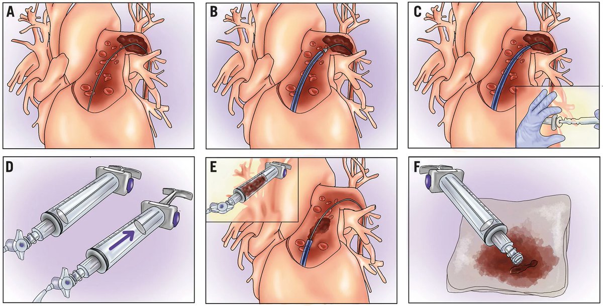 This review provides a practical outlook on catheter-directed therapies for pulmonary embolism, outlining optimal procedural planning, device selection, technical execution, evaluation of results, and management of complications. eurointervention.pcronline.com/article/cathet…