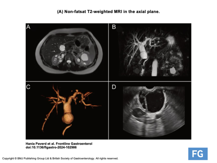 Frontline Gastro (@frontgastro_bmj) on Twitter photo 2 weeks of jaundice w/ CBD dilation to 17mm without choledocholithiasis on MRCP...what is your differential❓Check out this case report on Frontline Gastroenterology by Paverd et al. on a rare cause of biliary obstruction 🔗 bit.ly/4jJGULl <a href="/PhilSmithIsBack/">Phil Smith</a> <a href="/OTavabie/">Oliver Tavabie</a> 2 weeks of jaundice w/ CBD dilation to 17mm without choledocholithiasis on MRCP...what is your differential❓Check out this case report on Frontline Gastroenterology by Paverd et al. on a rare cause of biliary obstruction 🔗 bit.ly/4jJGULl <a href="/PhilSmithIsBack/">Phil Smith</a> <a href="/OTavabie/">Oliver Tavabie</a>