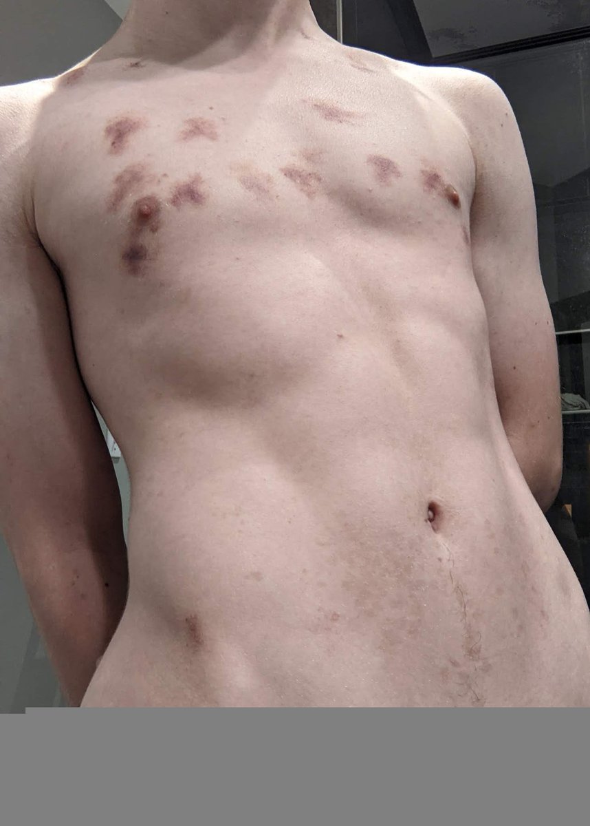 💞bites n scratches💞