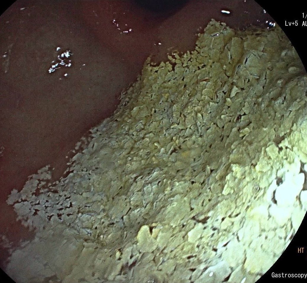 Endoscopic view of the stomach of a 33M with severe anaemia, abdominal pain and vomiting after meals. Case remains unresolved. What do you think is the cause?

📸: Sergiy Kharchenko
