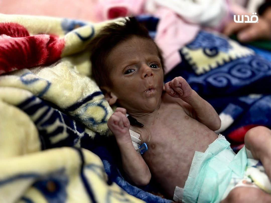 Nasem0n's tweet image. Malnourished children receive medical care at Nasser Hospital in Khan Yunis, as shortages of essential medicines and food continue due to the Israeli closure of crossings and the tightening of the siege on the Gaza Strip.