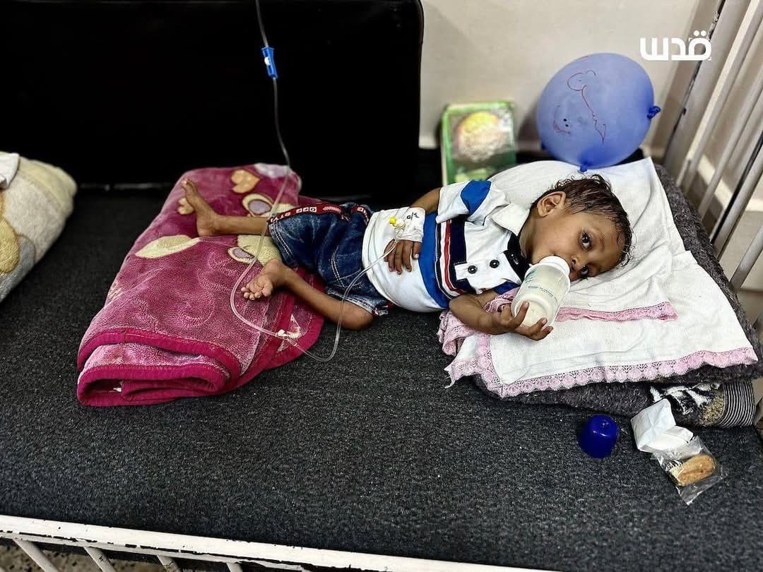 Nasem0n's tweet image. Malnourished children receive medical care at Nasser Hospital in Khan Yunis, as shortages of essential medicines and food continue due to the Israeli closure of crossings and the tightening of the siege on the Gaza Strip.