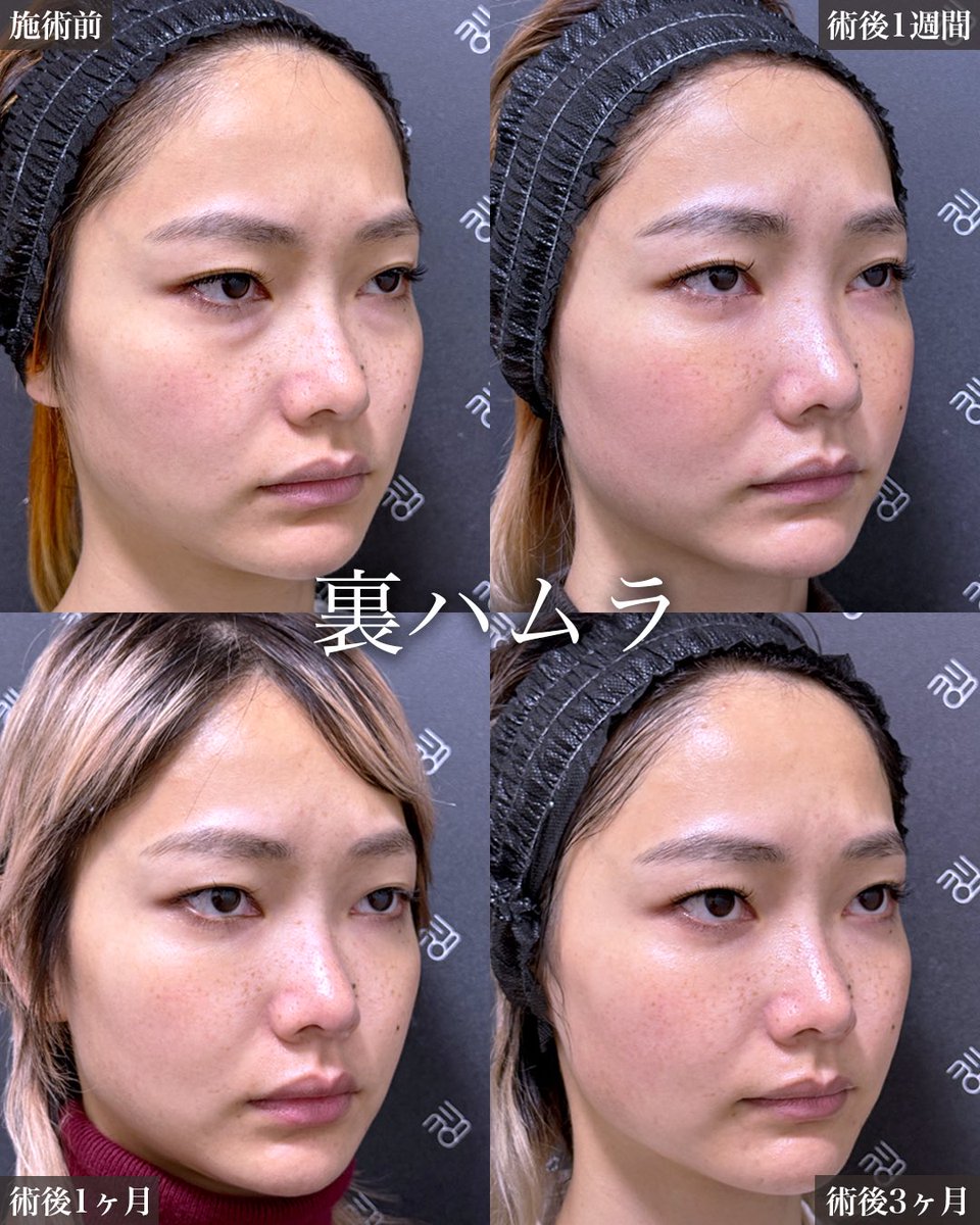 『裏ハムラ』の術後経過

腫れのピークは術後2,3日

1週間で8割程度腫れは引きます

細かく見るとそこから1ヶ月、3ヶ月、半年とさらにスッキリ自然に馴染んでいきます‼︎