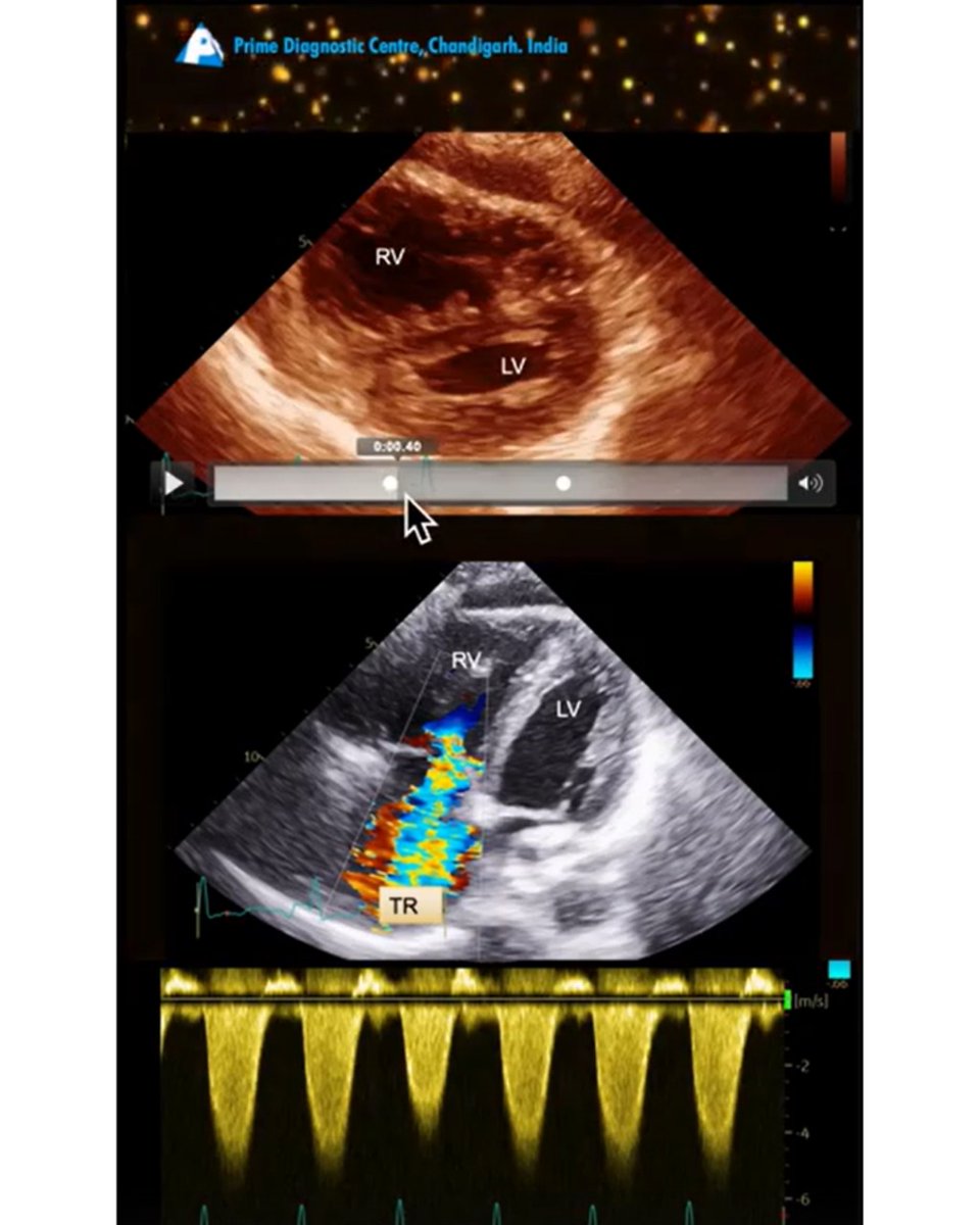 drupsinghin's tweet photo. What is the D Sign? 📈 Echo Example Showing D Sign in Systole & Diastole!
Watch Now: https://t.co/NYaP7dMmaS
#Echocardiography #DSign #CardiologyEducation #EchoTips #diagnosis #echosingh #prime https://t.co/w5Mdqs1wAr