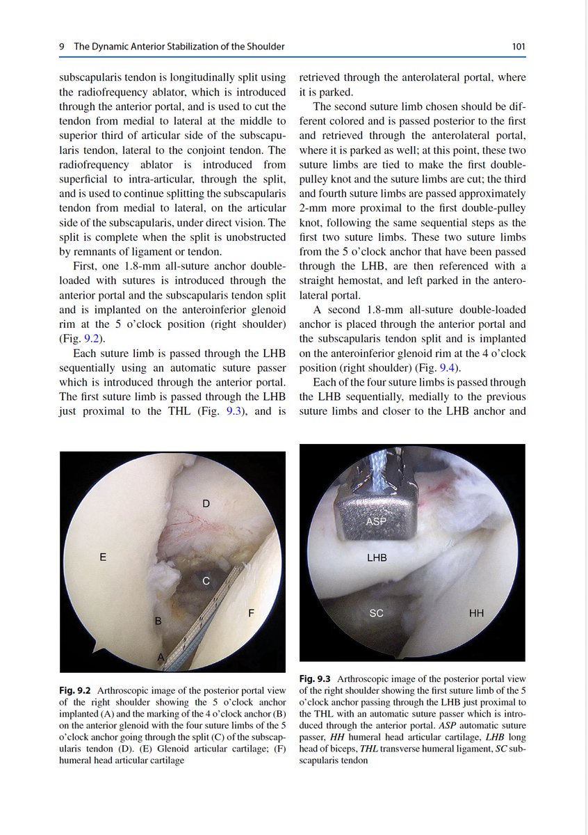 Clara Campos Azevedo, MD, PhD (@c_l_a_r_a_az) on Twitter photo We have written a new chapter on Dynamic Anterior Stabilization! This minimally invasive solution is one of the featured techniques in the book published by <a href="/ISAKOS/">ISAKOS</a> with <a href="/SpringerNature/">Springer Nature</a> , edited by Emilio Calvo, Giovanni Di Giacomo, and Augustus Mazzocca! link.springer.com/chapter/10.100… We have written a new chapter on Dynamic Anterior Stabilization! This minimally invasive solution is one of the featured techniques in the book published by <a href="/ISAKOS/">ISAKOS</a> with <a href="/SpringerNature/">Springer Nature</a> , edited by Emilio Calvo, Giovanni Di Giacomo, and Augustus Mazzocca! link.springer.com/chapter/10.100…