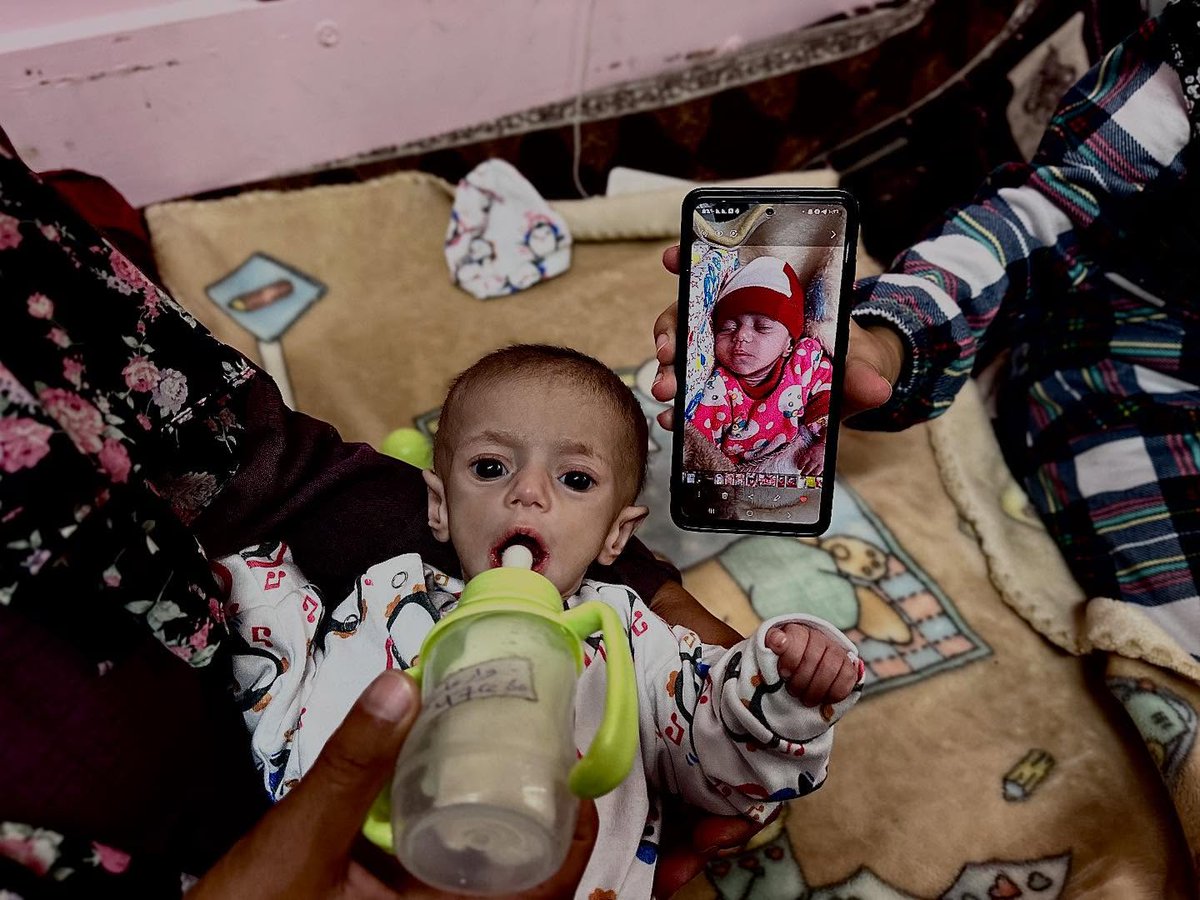 Suwar Ashour, a 5-month-old baby, was born during the war and suffers from malnutrition and emaciation due to the closure of the crossings and the lack of milk in the Gaza Strip. She is lying in Nasser Medical Complex in Khan Yunis, weighing 2.5 kilograms.