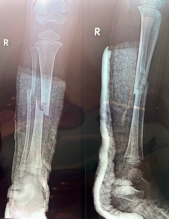 Children's fractures heal well and fast.The remodeling potential is very high.Not all fractures require surgery.