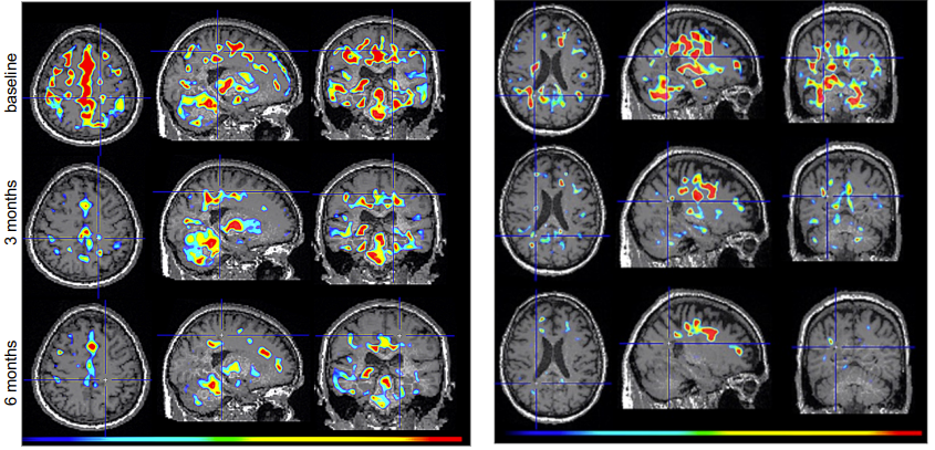 TizianaLS's tweet photo. Tiziana Life Sciences Announces Comprehensive Positive Results from Study of Nasal Foralumab in Patients with Multiple Sclerosis. Meaningful reduction in Fatigue scores seen, also stabilization of EDSS seen in all patients treated. 
$TLSA #MultipleSclerosis 
https://t.co/3G5XAfC557