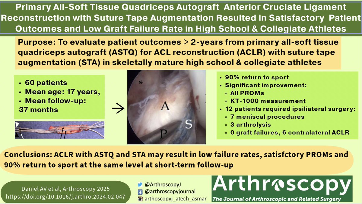 📢 📢 At minimum 2 year follow-up, this retrospective review of 60 high school &amp; collegiate athletes demonstrated NO graft failure and 90% return to sport rate after all soft tissue quadriceps tendon autograft ACLR. @columbiaortho ow.ly/v17l50VMJJn #ACLR #allsofttissue