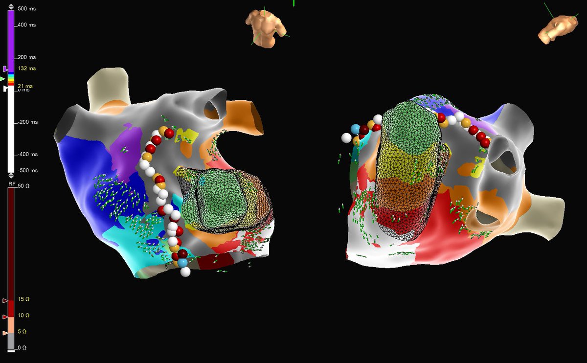 Flex Pulse dual energy redo lessons learned:

1. PFA first pass PVI/PWI durable.
2. Can terminate mitral flutter during PFA.
3. Sequential PFA/RF safe and effective. Turn up irrigation if RF second lesion.
4. Very versatile catheter.

Caution, investigative not FDA approved.