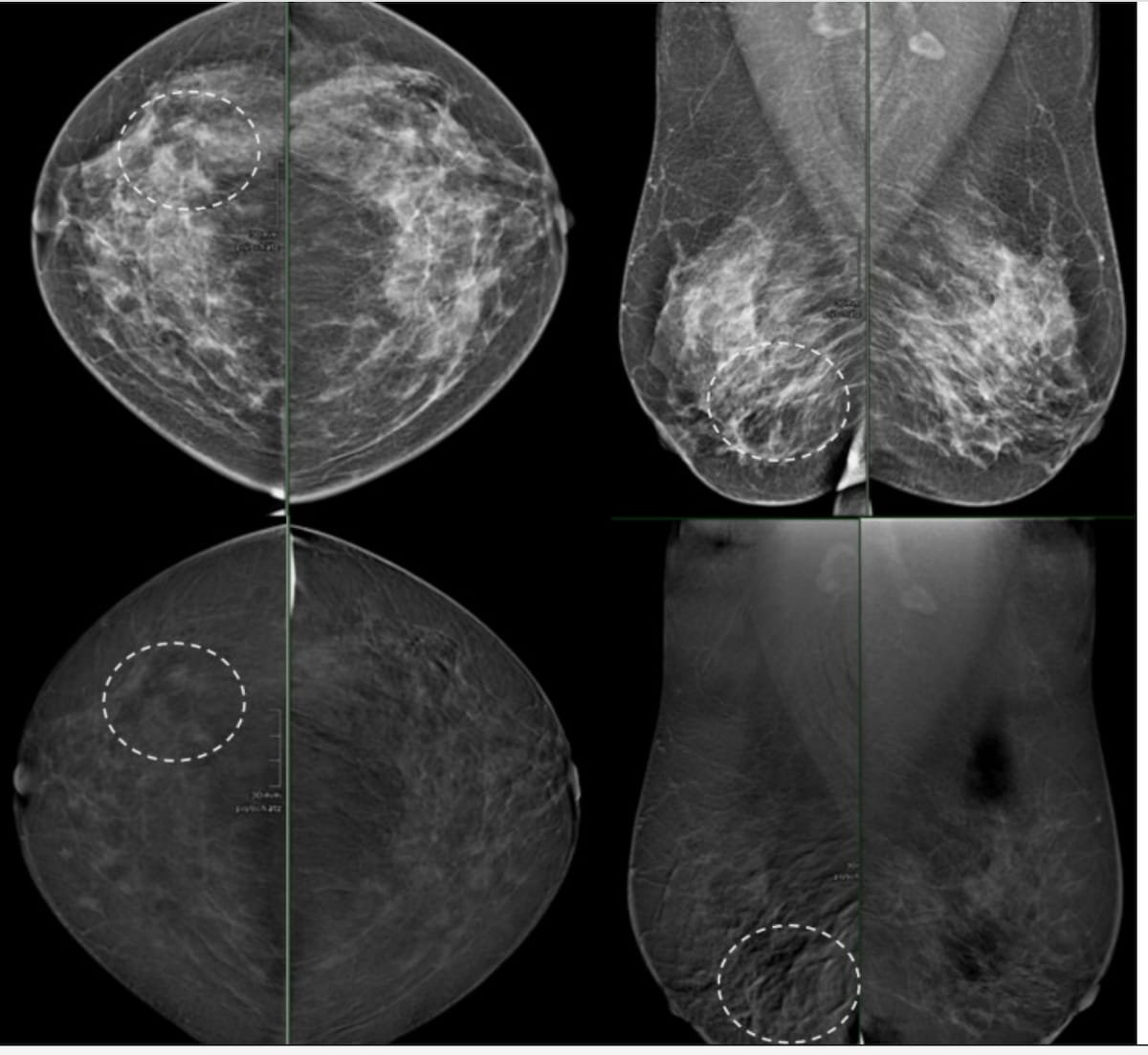Diagnostic Imaging (@dx_imaging) on Twitter photo Contrast-Enhanced #Mammography Study Reveals 24 Percent Lower Sensitivity with Moderate/Marked BPE
diagnosticimaging.com/view/contrast-…
<a href="/ACRRFS/">ACR RFS - We've Moved! Follow <a href="/RadiologyACR/">American College of Radiology</a>.</a> <a href="/ACRYPS/">ACR YPS- We've Moved! Follow @RadiologyACR.</a> @RadiologyACR <a href="/ARRS_Radiology/">ARRS</a> <a href="/JBI_SBI/">Journal of Breast Imaging</a> <a href="/SBIRFS/">SBI RFS</a> <a href="/WinshipAtEmory/">Winship Cancer Institute of Emory University</a> <a href="/PennRadiology/">Penn Radiology</a> <a href="/MontefioreRAD/">Montefiore Radiology</a> <a href="/UNCRadiology/">UNC Radiology</a> <a href="/Hopkins_Rad/">Johns Hopkins Radiology</a>
#radiology #RadRes Contrast-Enhanced #Mammography Study Reveals 24 Percent Lower Sensitivity with Moderate/Marked BPE
diagnosticimaging.com/view/contrast-…
<a href="/ACRRFS/">ACR RFS - We've Moved! Follow <a href="/RadiologyACR/">American College of Radiology</a>.</a> <a href="/ACRYPS/">ACR YPS- We've Moved! Follow @RadiologyACR.</a> @RadiologyACR <a href="/ARRS_Radiology/">ARRS</a> <a href="/JBI_SBI/">Journal of Breast Imaging</a> <a href="/SBIRFS/">SBI RFS</a> <a href="/WinshipAtEmory/">Winship Cancer Institute of Emory University</a> <a href="/PennRadiology/">Penn Radiology</a> <a href="/MontefioreRAD/">Montefiore Radiology</a> <a href="/UNCRadiology/">UNC Radiology</a> <a href="/Hopkins_Rad/">Johns Hopkins Radiology</a>
#radiology #RadRes