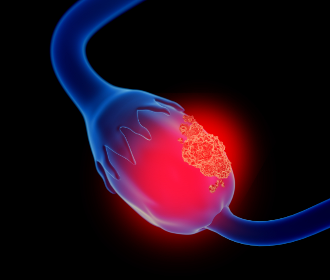 Precision Medicine (@iprecisionmed) on Twitter photo .<a href="/pitt_medicine/">University of Pittsburgh School of Medicine</a> identified a novel trigger of a deadly form of ovarian cancer. “This is the first report that stromal changes in the fallopian tube actually have a causative role in ovarian cancer initiation.” -Dr. Lan Coffman (<a href="/MageeWomens/">Magee-Womens Research Institute & Foundation</a> <a href="/UPMCHillmanCC/">UPMC Hillman Cancer Center</a>) medschool.pitt.edu/news/pitt-rese… .<a href="/pitt_medicine/">University of Pittsburgh School of Medicine</a> identified a novel trigger of a deadly form of ovarian cancer. “This is the first report that stromal changes in the fallopian tube actually have a causative role in ovarian cancer initiation.” -Dr. Lan Coffman (<a href="/MageeWomens/">Magee-Womens Research Institute & Foundation</a> <a href="/UPMCHillmanCC/">UPMC Hillman Cancer Center</a>) medschool.pitt.edu/news/pitt-rese…