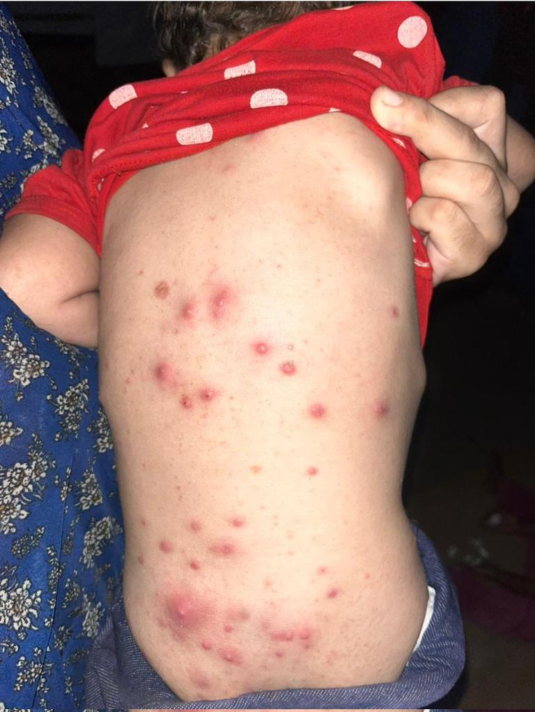 yousefQasem1998's tweet image. DONT SCROLLING PLEASE , I BEG U

The infection spread throughout
 Nimir's baby girls entire body Namir needs to get her kids out of g@za please help them ASAP
THEIR TREATMENT IS NOT WORKING AND THE WEATHER IS MAKING IT WORSE.
 
HELP ME GET TREATMENT
gofundme.com/f/help-yousefs…
#bb26