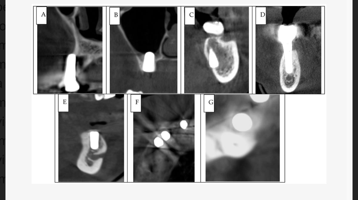 Glad to share that our latest research article has been published in a Q1 journal! 🎉

Huge thanks to our supervisors and analyst for their guidance and support throughout the journey. 

mdpi.com/2077-0383/14/9…