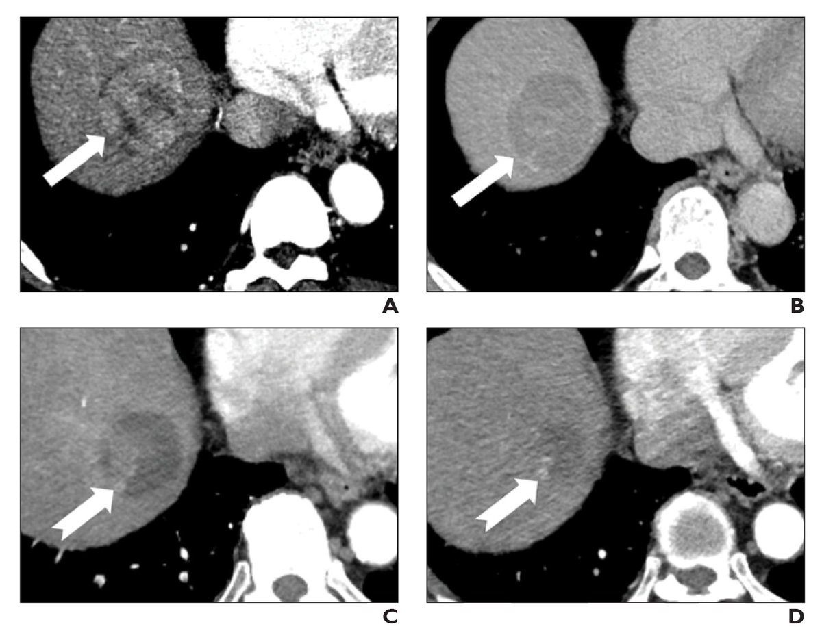 The LI-RADS CT/MRI Radiation TRA v2024 refines early response assessment, provides prognostic utility, and informs further management strategies after Y-90 radioembolization for HCC.

ajronline.org/doi/10.2214/AJ…