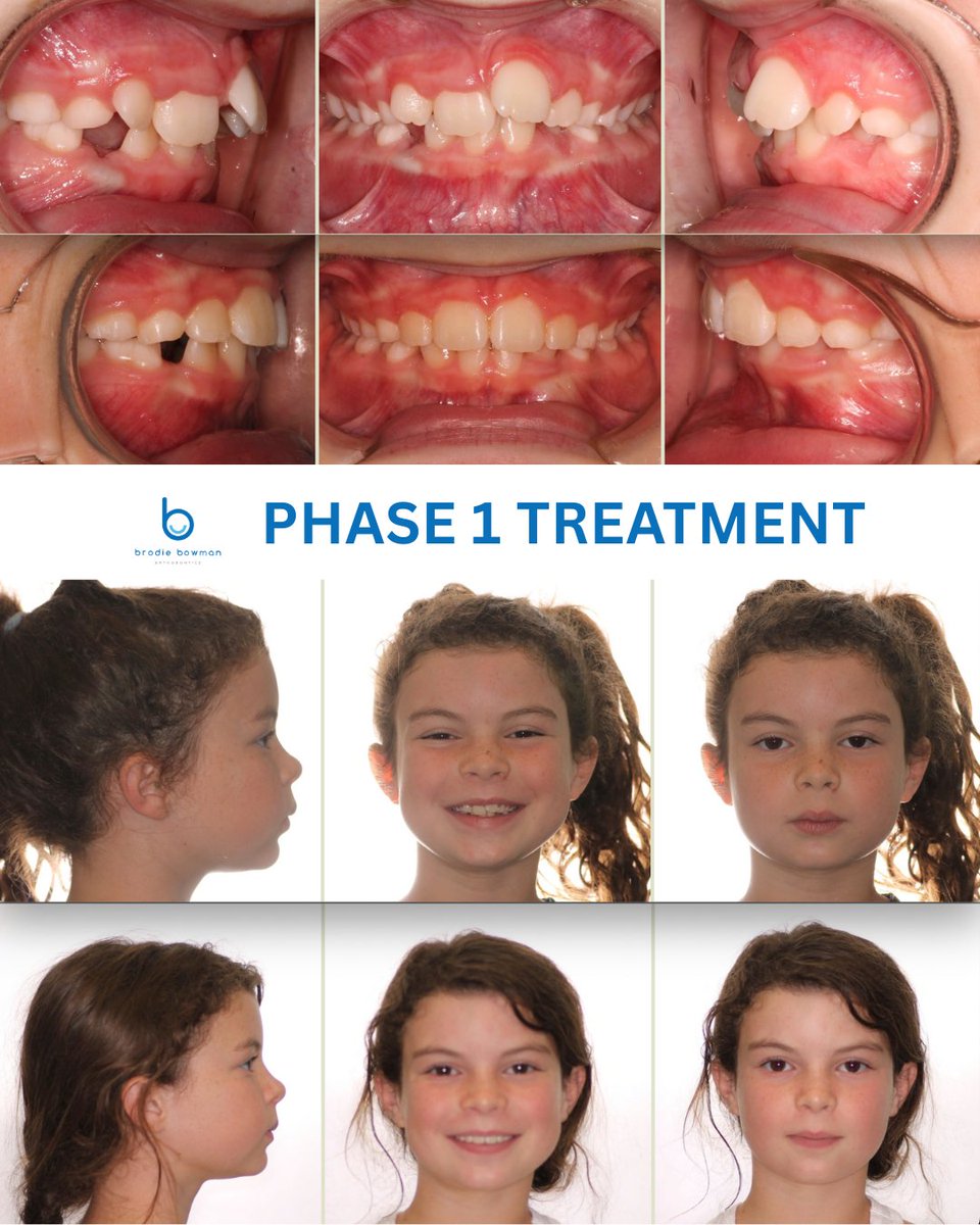BowmanOrtho's tweet image. From 😬 to 😁 — what a glow-up!
Two-phase treatment = confident smile, healthy bite, and big results!
This transformation says it all. 

#brodiebowmanorthodontics #orthodontics #invisalignprovider #kidsbraces #teethstraightening #orthodontictreatment #dentalbraces #nicevilleortho