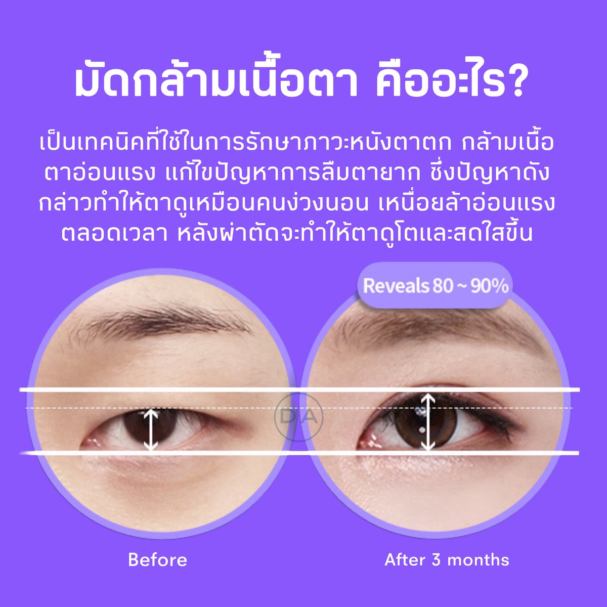 DAofficialTH's tweet photo. 🏥DA original✨You deserve the best. 💎 
มาทำความรู้จัก“ การมัดกล้ามเนื้อตา”👁️
#DAoriginal #โรงพยาบาลดีเอ
#ลูกสาวดีเอ #ลูกชายดีเอ https://t.co/VpdVq8J75k