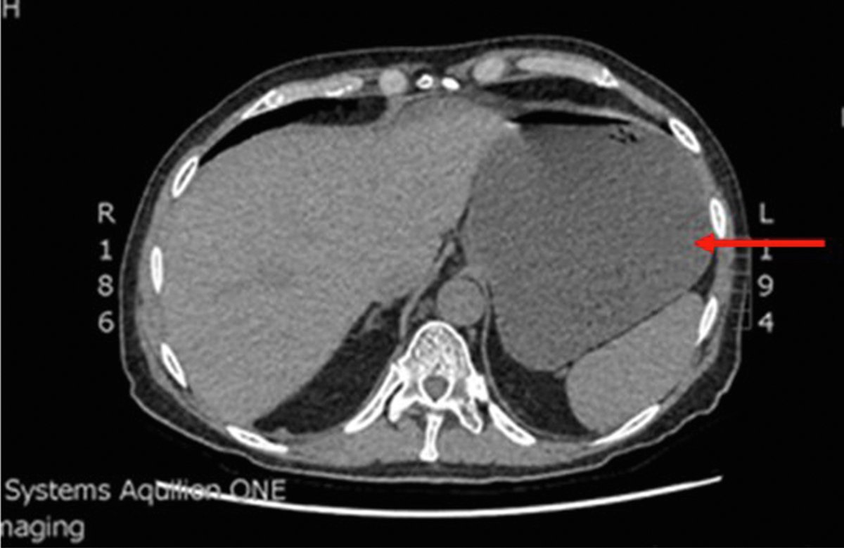 JACC Journals (@jaccjournals) on Twitter photo 73M on holiday presented w/ lower abdominal pain, nausea & vomiting after eating chicken. Mildly distended but soft abdomen w/ mild discomfort at the epigastric area. Vitals were unremarkable. jacc.org/doi/10.1016/j.…
#Heartcongress2025 #JACCCaseReports #ECG <a href="/HeartCongress25/">Kristina Pierce</a> 73M on holiday presented w/ lower abdominal pain, nausea & vomiting after eating chicken. Mildly distended but soft abdomen w/ mild discomfort at the epigastric area. Vitals were unremarkable. jacc.org/doi/10.1016/j.…
#Heartcongress2025 #JACCCaseReports #ECG <a href="/HeartCongress25/">Kristina Pierce</a>