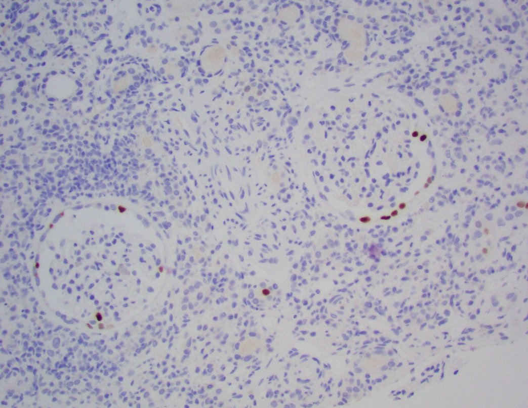 Polyoma virus 'crescents' in a case of BK nephropathy in a kidney transplant patient. SV40 demonstrates parietal epithelial cell positivity on deeper levels. BK viremia &gt;3 million recently.  #renalpath #pathtwitter #nephrology