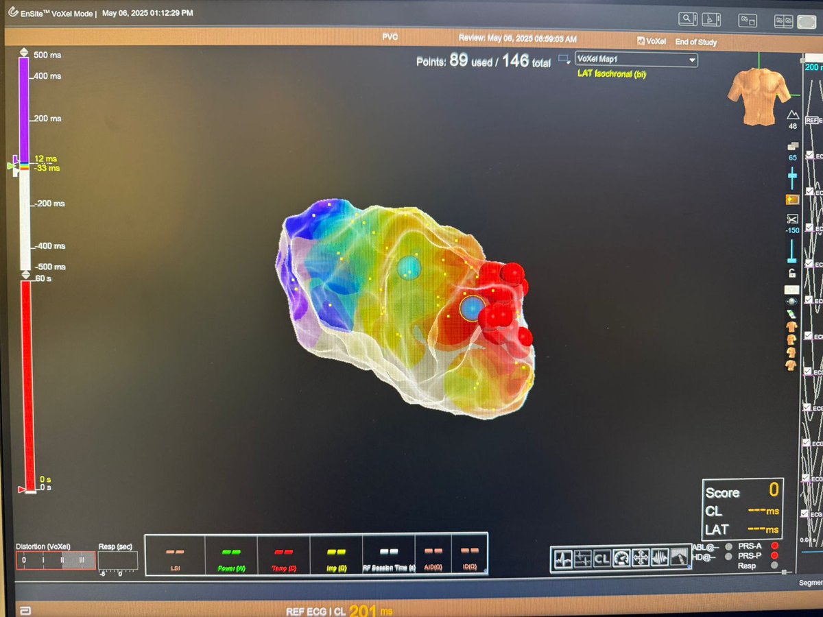 Bernard Abi-Saleh MD (@abisalehbernard) on Twitter photo Fasicular origin of a PVC inducing VF in a HOCM patient with multiple shocks <a href="/AUBMC_Official/">American University of Beirut Medical Center</a> <a href="/AUB_Lebanon/">American University of Beirut</a> <a href="/AbbottCardio/">Abbott Cardiovascular</a> Fasicular origin of a PVC inducing VF in a HOCM patient with multiple shocks <a href="/AUBMC_Official/">American University of Beirut Medical Center</a> <a href="/AUB_Lebanon/">American University of Beirut</a> <a href="/AbbottCardio/">Abbott Cardiovascular</a>