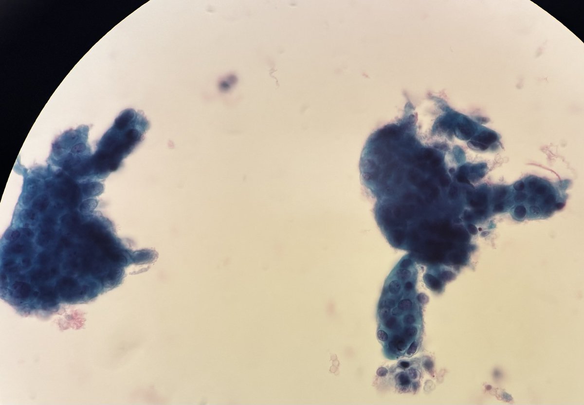 israhkhan's tweet image. Beware of bloody unsats 
#Paptest , Tumor cells hiding within diathesis