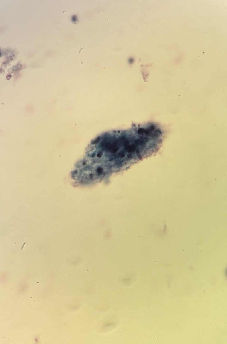 israhkhan's tweet image. Beware of bloody unsats 
#Paptest , Tumor cells hiding within diathesis