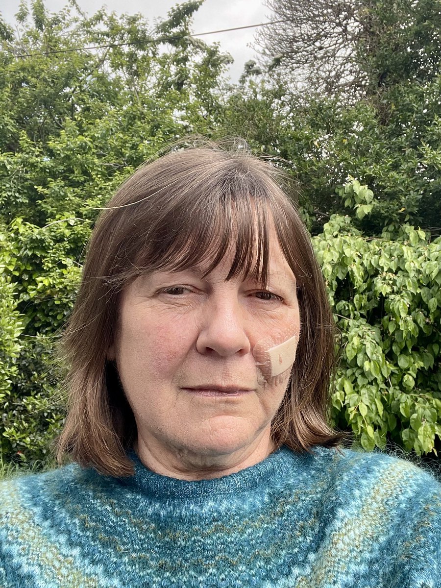 Had a basal cell carcinoma removed today - had no idea until recently that what I thought was a simple mole wasn’t!
Luckily it’s not something sinister. Just goes to show you need to get skin changes checked out.
Now just no smiling for 24hrs to let the incision settle!