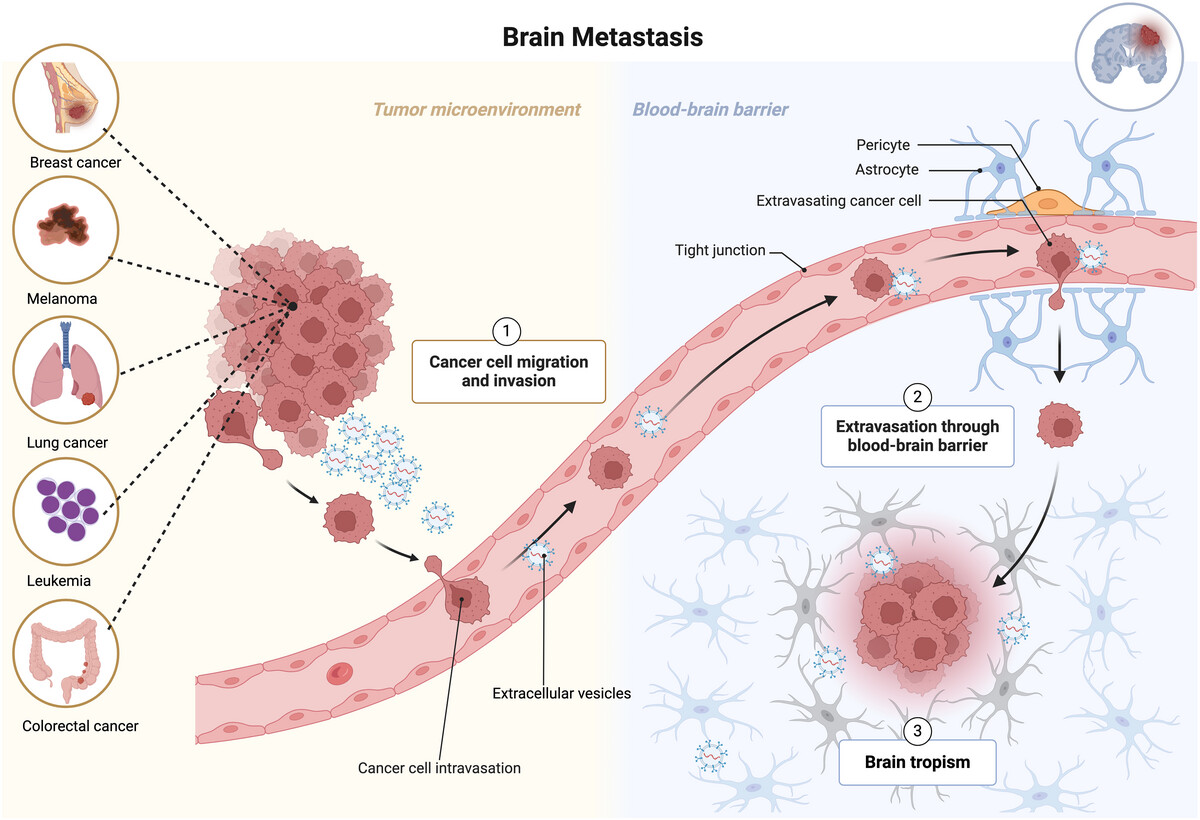 ISEV-Journals (@isev_journals) on Twitter photo 🆕New in #JExBio🆕This review focuses on the role of EVs in brain metastasis, including disruption of the BBB, preparing the pre-metastatic niche, modulating the immune system and their potential as diagnostic/prognostic biomarkers for brain metastasis isevjournals.onlinelibrary.wiley.com/doi/10.1002/je… 🆕New in #JExBio🆕This review focuses on the role of EVs in brain metastasis, including disruption of the BBB, preparing the pre-metastatic niche, modulating the immune system and their potential as diagnostic/prognostic biomarkers for brain metastasis isevjournals.onlinelibrary.wiley.com/doi/10.1002/je…
