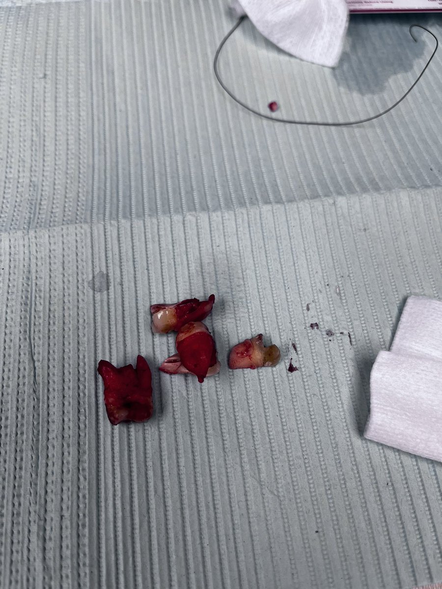The Field of 68 (@thefieldof68) on Twitter photo Our guy <a href="/RobDauster/">Rob Dauster</a> has just set a record for the oldest person to have their wisdom teeth removed.
“My dad cried like a baby,” his son Chase said. “I got my toughness from my mom.”
Sources also indicate that there is growing concern regarding DRY SOCKET. Our guy <a href="/RobDauster/">Rob Dauster</a> has just set a record for the oldest person to have their wisdom teeth removed.
“My dad cried like a baby,” his son Chase said. “I got my toughness from my mom.”
Sources also indicate that there is growing concern regarding DRY SOCKET.