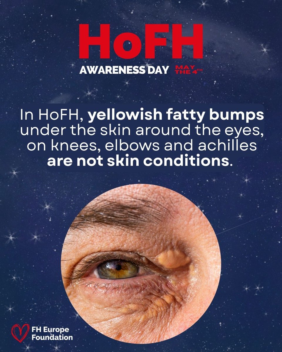 RARE Revolution Magazine (@rarerevolutionm) on Twitter photo Xanthomas and xanthelasmas are signs of excess cholesterol, often seen in childhood. These fatty deposits can cause discomfort and concern. Know the symptoms! #Unite4HoFH #KnowHoFH #RareDisease #Maythe4thbewithyou #HoFHAwarenessDay <a href="/fhpatienteurope/">FH Europe Foundation</a> Xanthomas and xanthelasmas are signs of excess cholesterol, often seen in childhood. These fatty deposits can cause discomfort and concern. Know the symptoms! #Unite4HoFH #KnowHoFH #RareDisease #Maythe4thbewithyou #HoFHAwarenessDay <a href="/fhpatienteurope/">FH Europe Foundation</a>