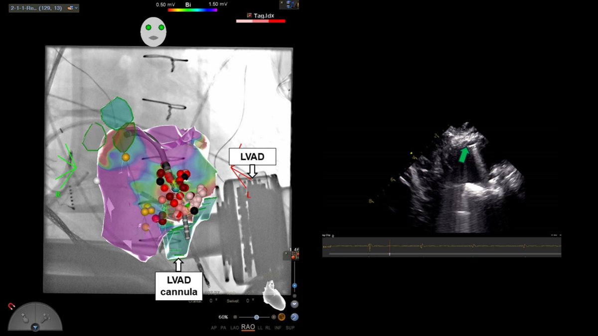 Pasquale Santangeli (@dr_santangeli) on Twitter photo Management of ventricular tachycardia in patients with advanced heart failure
<a href="/ioanliuba/">Ioan Liuba</a> <a href="/SroubekJ/">Jakub Sroubek</a> <a href="/CleClinicHVTI/">Cleveland Clinic Heart, Vascular & Thoracic</a> sciencedirect.com/science/articl… Management of ventricular tachycardia in patients with advanced heart failure
<a href="/ioanliuba/">Ioan Liuba</a> <a href="/SroubekJ/">Jakub Sroubek</a> <a href="/CleClinicHVTI/">Cleveland Clinic Heart, Vascular & Thoracic</a> sciencedirect.com/science/articl…