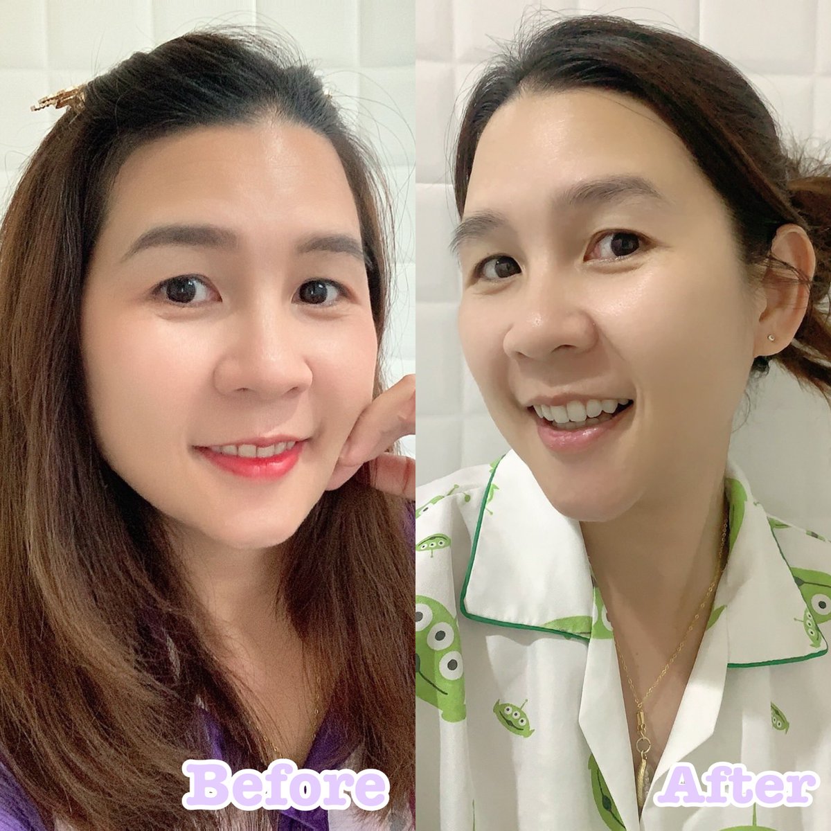 p_patchada's tweet image. โครตจะดีย์ โครตจะจึ้ง นีเวีย แอคเน่ แคร์ ไมเซล่า คลีนซิ่งที่ช่วยดูดจับสิ่งสกปรก เมคอัพได้หมดเกลี้ยง แถมยังลดการเกิดสิว ช่วยเติมความชุ่มชื้นให้ผิว แค่เช็ดก็ได้ทั้งทำความสะอาดผิวหน้าและบำรุงในครั้งเดียว พักหน้าง่ายๆได้ทุกวัน #ใช้เองรีวิวจริง #ถูกและดี