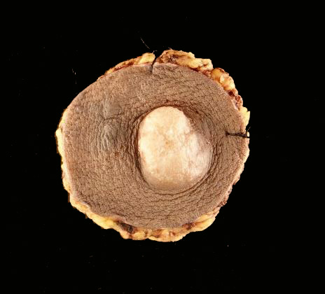 ModernPathology's tweet image. Despite new discoveries, we still need to remind our surgical colleagues that dermatofibrosarcoma protuberans tracks along connective tissue septa well past where the surgeon anticipates.
Smith SC, Sweeney K, Evans MG, Angara K, Reynolds C, Price B, Park SJ, Elliott A, Oberley…