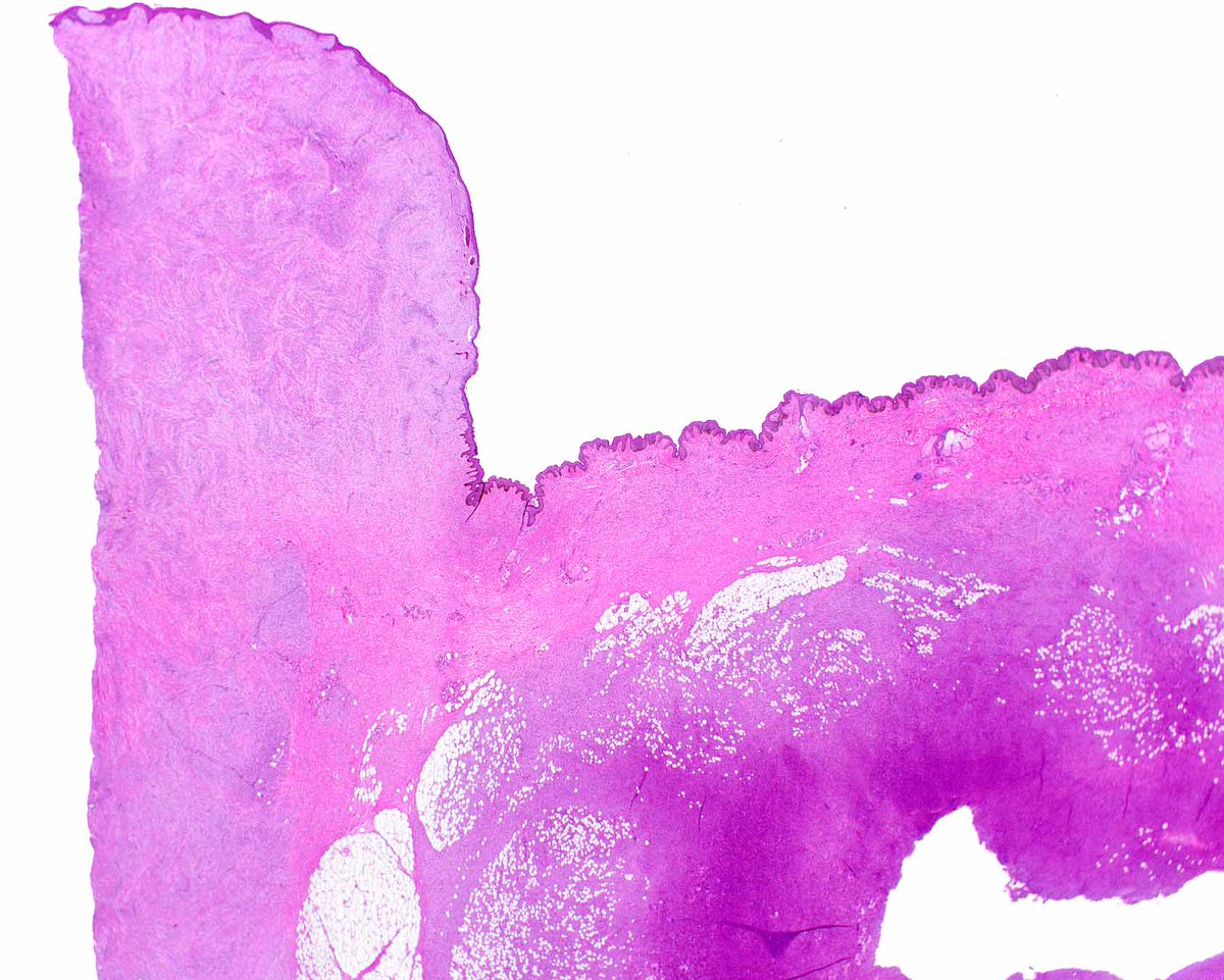 ModernPathology's tweet image. Despite new discoveries, we still need to remind our surgical colleagues that dermatofibrosarcoma protuberans tracks along connective tissue septa well past where the surgeon anticipates.
Smith SC, Sweeney K, Evans MG, Angara K, Reynolds C, Price B, Park SJ, Elliott A, Oberley…