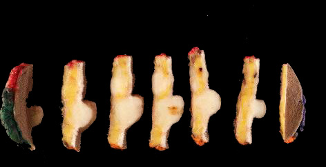 ModernPathology's tweet image. Despite new discoveries, we still need to remind our surgical colleagues that dermatofibrosarcoma protuberans tracks along connective tissue septa well past where the surgeon anticipates.
Smith SC, Sweeney K, Evans MG, Angara K, Reynolds C, Price B, Park SJ, Elliott A, Oberley…