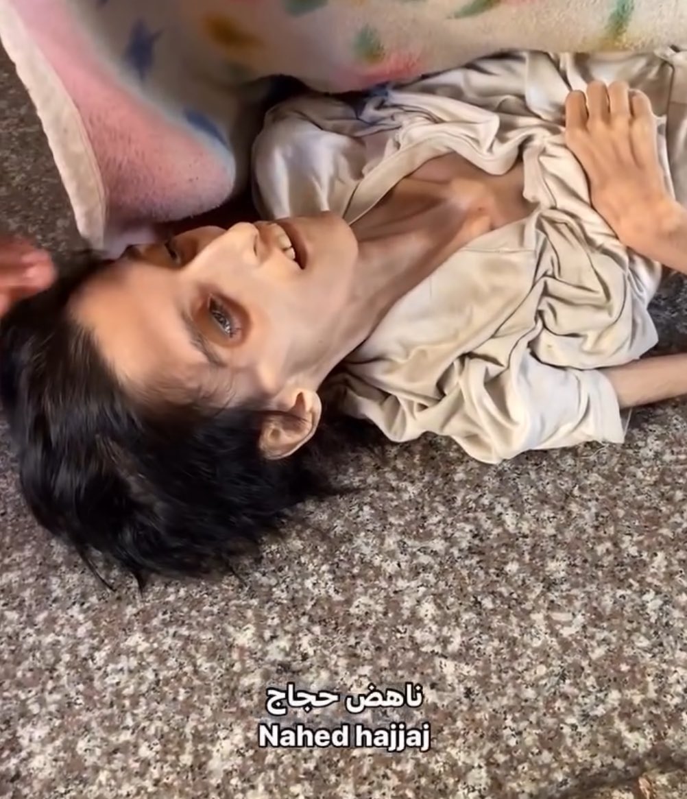 6 March 2025

In Gaza, people who survive Israeli bombing die from malnutrition and dehydration!