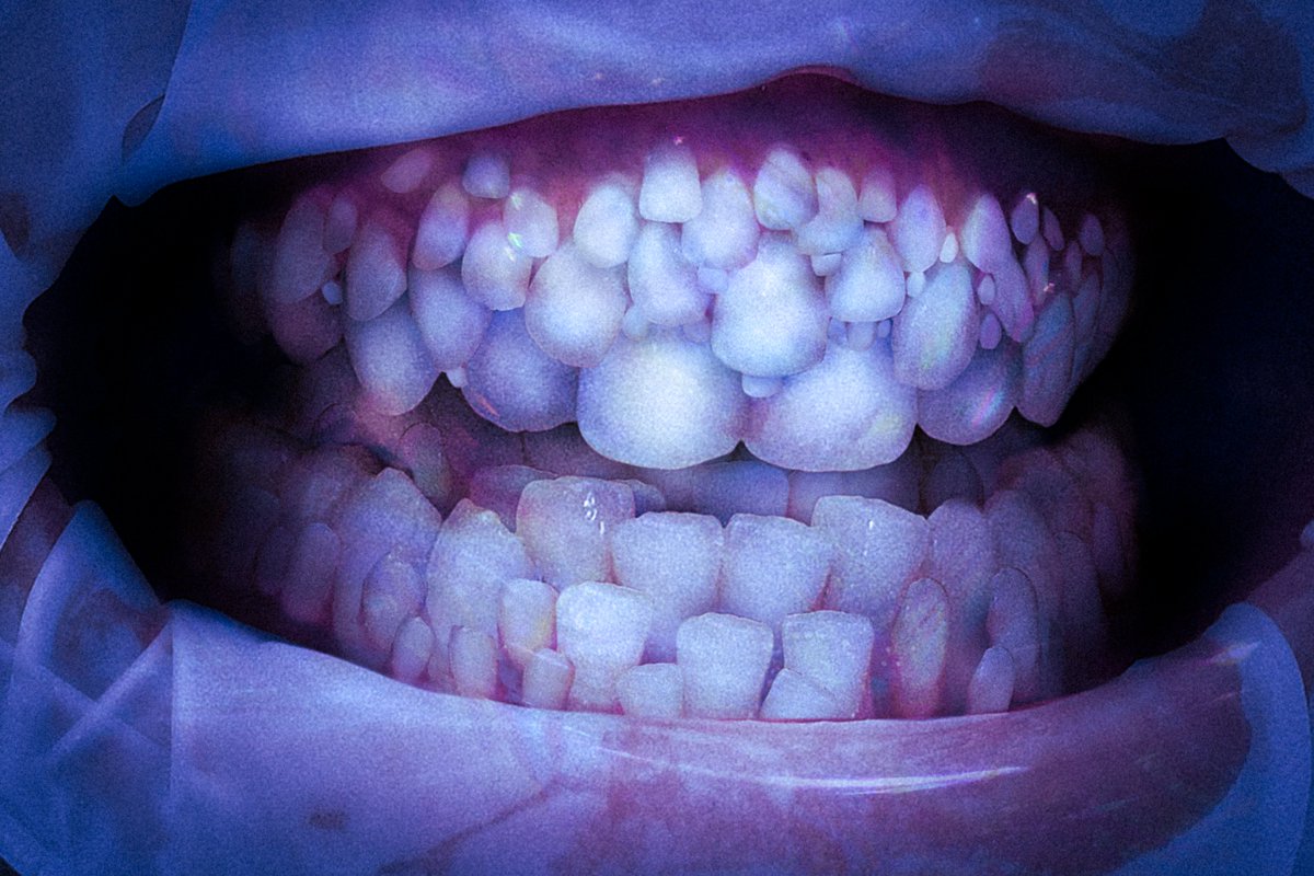 It is estimated that by 2016, every human has dangerous concentrations of Hausdorff-D2.5 in their blood.
The first to be affected by Fractal Syndrome have seen their symptoms worsen over years, slowly turning life-threatening. Their bodies cannot sustain the level of growth.