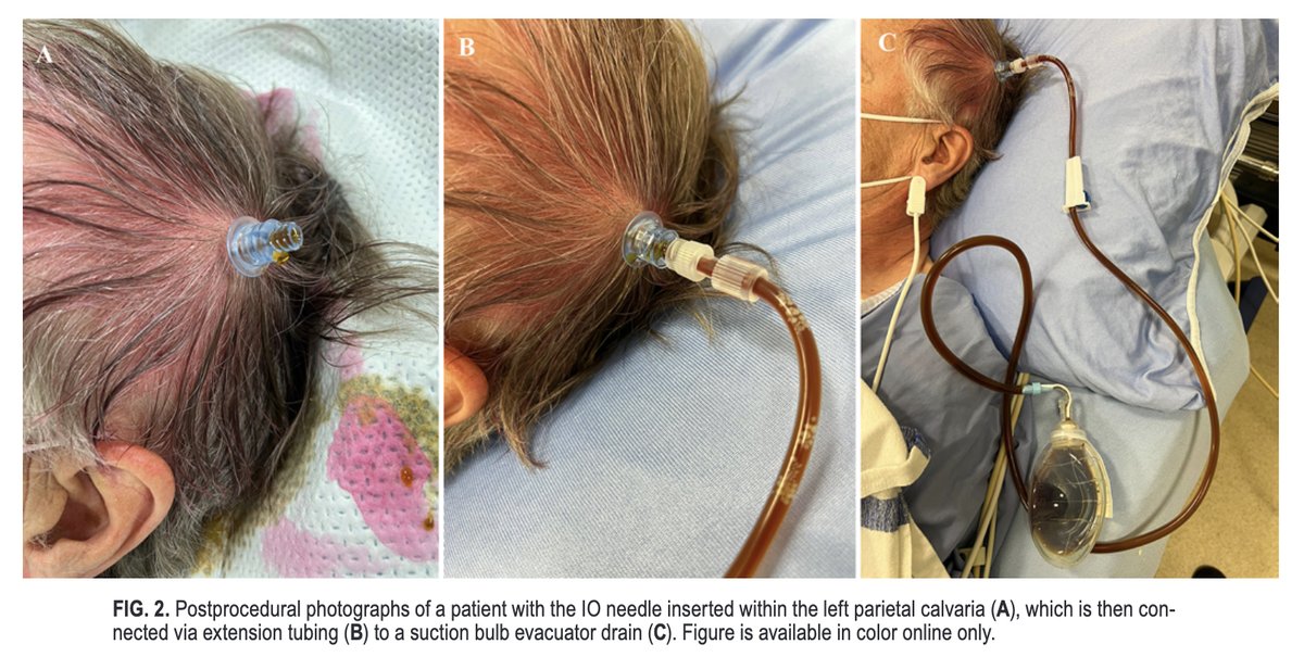 #OnlineFirst: Intraosseous needle for management of subacute and chronic subdural hematoma. 

thejns.org/view/journals/….
