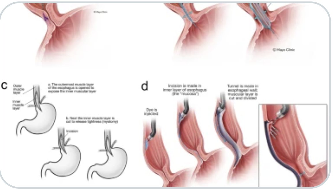 Abdominal Radiology (@abdominal_rad) on Twitter photo Imaging following endoscopic and surgical treatment of achalasia.
Kristina Flicek et al
link.springer.com/article/10.100…
#AbdRadJ
<a href="/RadGeek/">Neeraj Lalwani</a>
<a href="/LetDdiceFlyHigh/">Sandeep Arora</a> Imaging following endoscopic and surgical treatment of achalasia.
Kristina Flicek et al
link.springer.com/article/10.100…
#AbdRadJ
<a href="/RadGeek/">Neeraj Lalwani</a>
<a href="/LetDdiceFlyHigh/">Sandeep Arora</a>