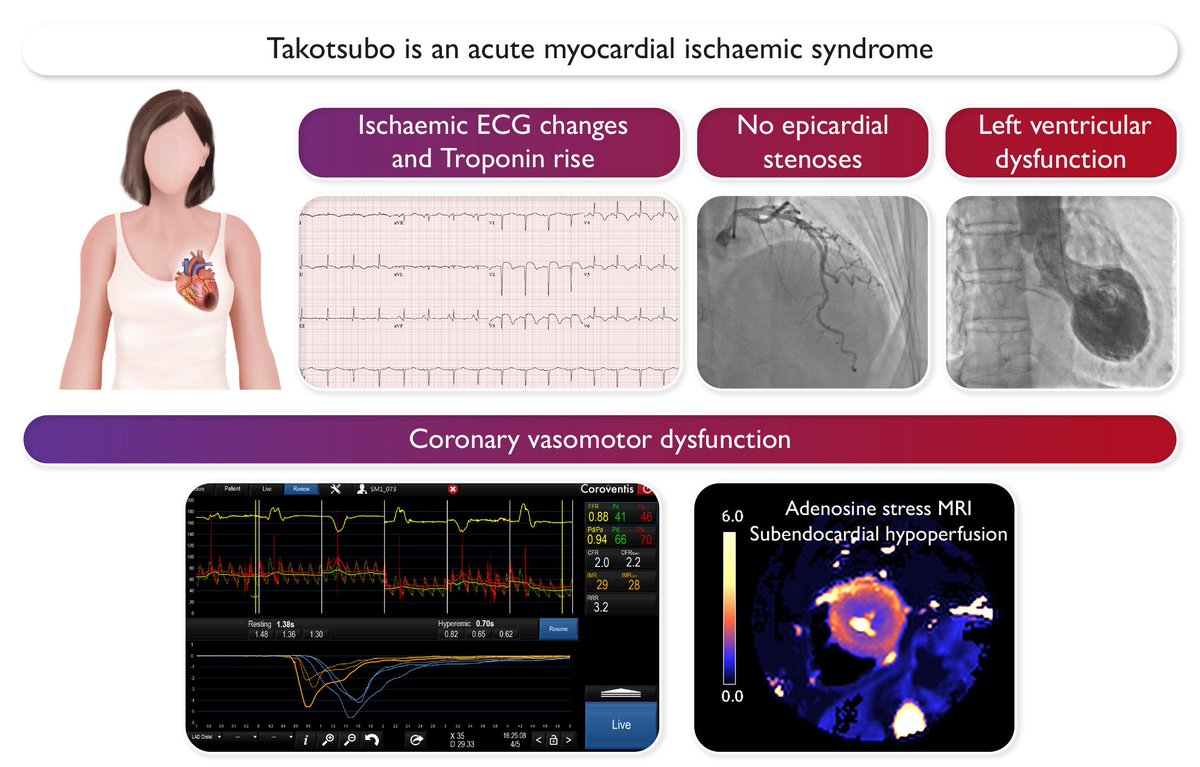 EHJ Editor-in-Chief (@ehj_ed) on Twitter photo Takotsubo syndrome: a candidate for being an acute myocardial ischaemic syndrome?
academic.oup.com/eurheartj/arti…
#EHJ #cardiotwitter #Takotsubo #MINOCA @ESC_journals <a href="/escardio/">European Society of Cardiology</a> Takotsubo syndrome: a candidate for being an acute myocardial ischaemic syndrome?
academic.oup.com/eurheartj/arti…
#EHJ #cardiotwitter #Takotsubo #MINOCA @ESC_journals <a href="/escardio/">European Society of Cardiology</a>