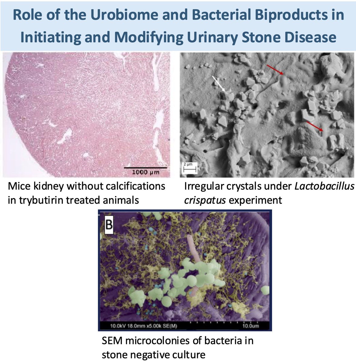 New collaborative analysis on the role of the urobiome and microbial metabolites in urinary stone pathogenesis. We explore oxalate-independent pathways, species-specific crystallization patterns, and endotoxin-driven inflammation/sepsis risk. bit.ly/4kb8f93 #AUANews