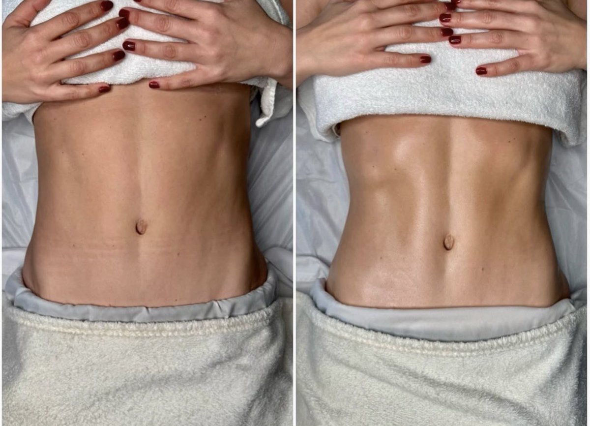 i am once again asking you to try lymphatic drainage massage it you are bloated. inflamed. fatigued for no reason. holding onto excess water. your skin is dull, your digestion is slow, and your immune system is struggling. 

this will de puff your entire body by draining excess