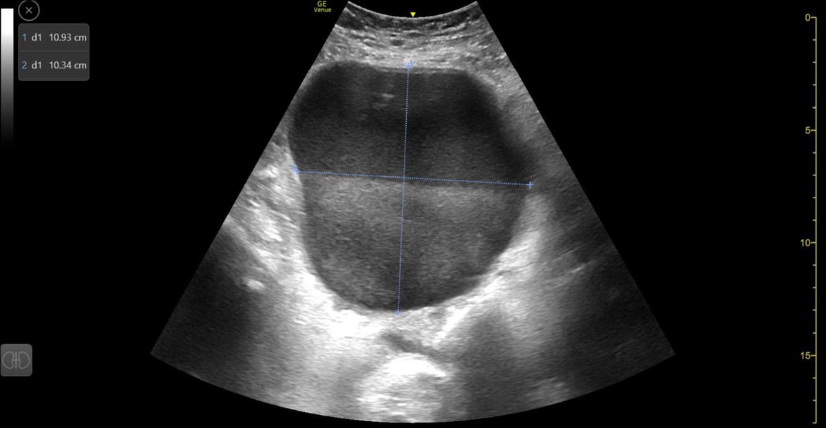 Pocus_PR's tweet image. 🔔#CasoPOCUS 
👩‍💼 28 años. Conización hace 3 semanas. 
🏥 Tras varias consultas, ingresa por “Pielonefritis”. 
🤒Fiebre 1 semana. Dolor y pesadez hipogastrio. PPR-. Urocultivo -.
🧪Riñón bien. RFA elevados. Hb baja 2 puntos. 
🤲Masa en hipogastrio. 
 
👀 Tras POCUS, ¿sospecha?