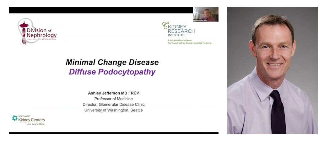 UW Nephrology (@uwnephrology) on Twitter photo Professor Ashley Jefferson, MD, shares information regarding the many advances in Minimal Change Disease in this Grand Rounds presentation on Diffuse Podocytopathy. #FSGS #MinimalChangeDisease #Podocyte #nephtwitter @uwmedicine 
Watch - youtu.be/lhy-p1212TI Professor Ashley Jefferson, MD, shares information regarding the many advances in Minimal Change Disease in this Grand Rounds presentation on Diffuse Podocytopathy. #FSGS #MinimalChangeDisease #Podocyte #nephtwitter @uwmedicine 
Watch - youtu.be/lhy-p1212TI