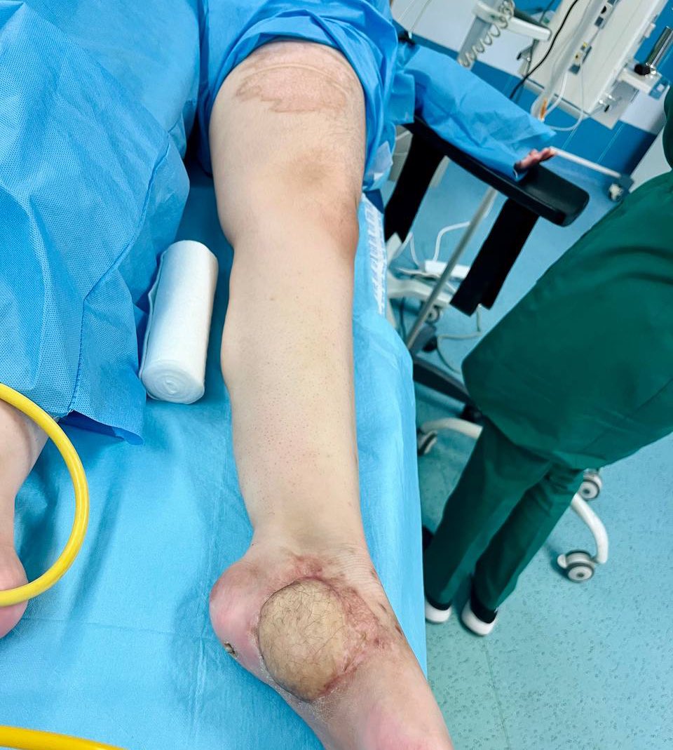 گرفت از ران به کف پا
(چون پوست ران فولیکول مو داره، به همین خاطر کف پاش مو درآورده)
پ‌ن: دختر‌ دنبال پروانه افتاده که میوفته و مچ و کف پاش آسیب میبینه
مواظب خودتون باشید….