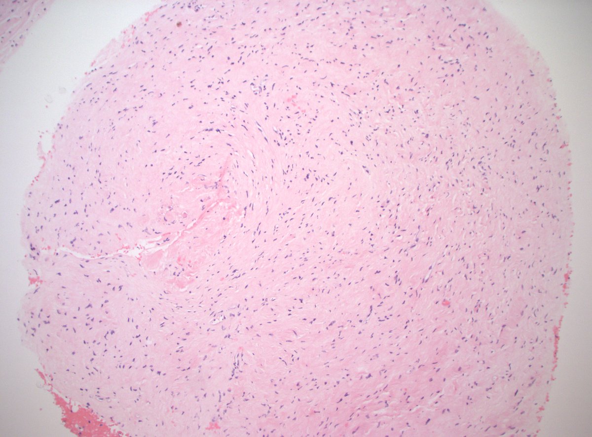 For opinions please. 40sM 9cm posterior shoulder subcutaneous mass, present for 10yrs. S100 shows some staining (see below). SOX10, SMA, CD34, CK are negative. Dx or further workup?

#BSTpath #PathTwitter #PathX