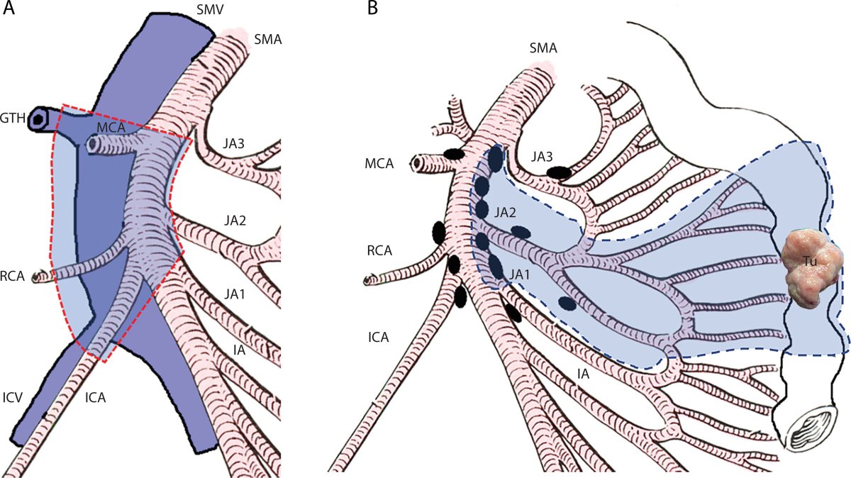 DCRjournal (@dcrjournal) on Twitter photo Jejunal lymphatic & vascular anatomy as applied to oncologic resection. Read more in this month's #DCRJournal: bit.ly/3S9J62q
<a href="/TeodorVasic1/">TeodorVasic</a> <a href="/dexexer01/">Dejan Ignjatovic</a> <a href="/UniOslo/">Universitetet i Oslo</a> #ColorectalSurgery @fascrs_updates Jejunal lymphatic & vascular anatomy as applied to oncologic resection. Read more in this month's #DCRJournal: bit.ly/3S9J62q
<a href="/TeodorVasic1/">TeodorVasic</a> <a href="/dexexer01/">Dejan Ignjatovic</a> <a href="/UniOslo/">Universitetet i Oslo</a> #ColorectalSurgery @fascrs_updates