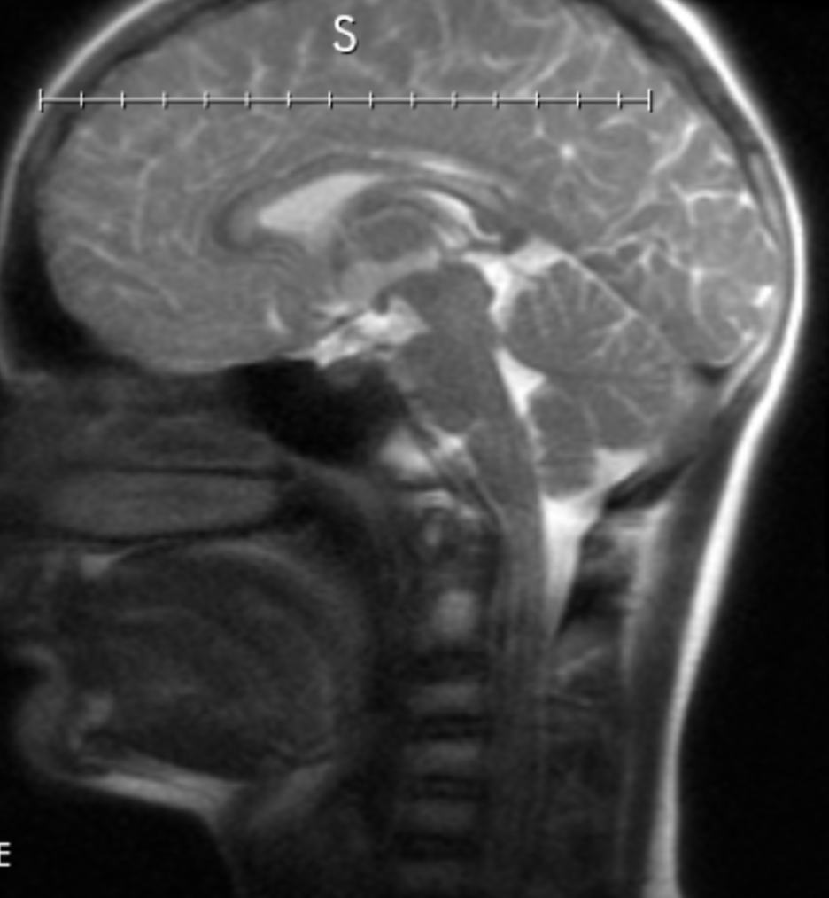 Next step in our son's #longcovid journey is to address various blood flow and brain / stem issues. Could be inflammation related, could be connective tissue related ... so much more to learn.