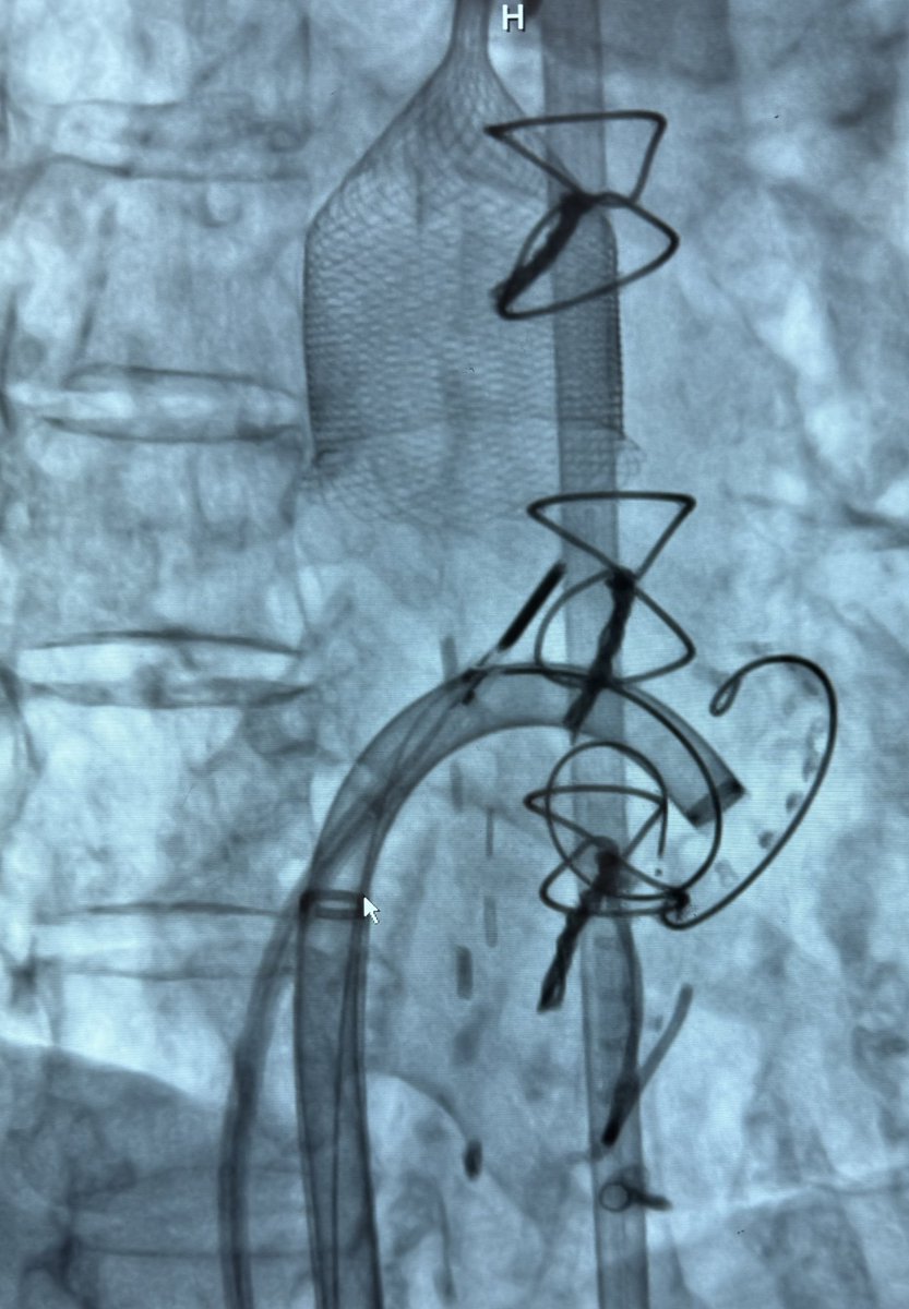 Ahmad Jabri MD , FACC, FSCAI (@ahmadjabri8) on Twitter photo Mitral valve mass extraction using <a href="/InariMedical/">Inari Medical</a> Triever20 Curve paired with <a href="/ONOCORvascular/">ŌNŌCOR</a> for full embolic protection under ICE guidance.
Shoutout to the brilliant minds. Herman Kado <a href="/g_giustinoMD/">Gennaro Giustino, MD</a> <a href="/PedroMDMSc/">Pedro Villablanca MD, MSc, FACC, FSCAI</a> Mitral valve mass extraction using <a href="/InariMedical/">Inari Medical</a> Triever20 Curve paired with <a href="/ONOCORvascular/">ŌNŌCOR</a> for full embolic protection under ICE guidance.
Shoutout to the brilliant minds. Herman Kado <a href="/g_giustinoMD/">Gennaro Giustino, MD</a> <a href="/PedroMDMSc/">Pedro Villablanca MD, MSc, FACC, FSCAI</a>